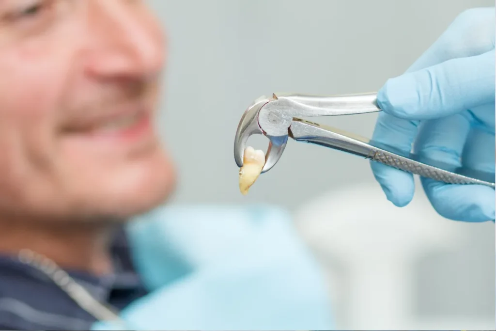 Dentist holding extracted wisdom tooth with dental forceps after successful tooth removal procedure